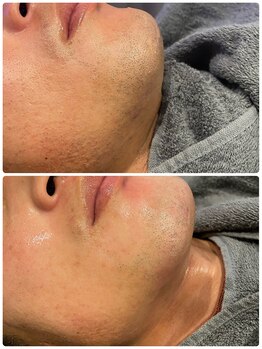 ワイズサロン(Y's salon)/ひげ脱毛5回終了からの2週間後