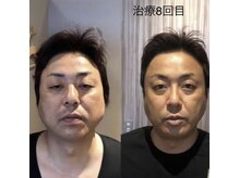 せせらぎ鍼灸院/鬼美容鍼 before&after/施術8回