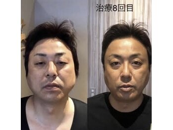 せせらぎ鍼灸院/鬼美容鍼 before&after/施術8回