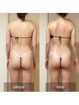 ココカラ(COCOKARA)/インディバ　肩の盛り上がり改善