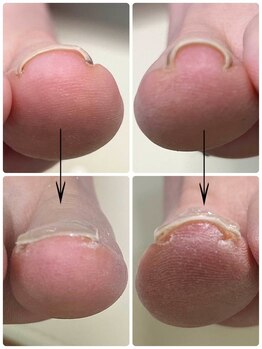 一宮巻き爪センター/巻き爪