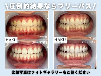 ハク 袋井磐田店(HAKU)の写真/【1番人氣◎】短期集中で圧倒的結果！自分史上最高に白い歯が手に入る！一氣にお悩み解決！
