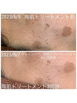 ククナ(KUKUna)/シミや毛穴改善◎目で見て分かる