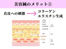 ビシンラボ(美SIN LAB)/美容鍼2：コラーゲンエラスチン