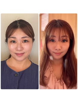 小顔矯正サロン ブルーム/施術1回のビフォーアフター