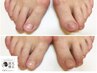 【男性/フット深爪矯正】長年の深爪から卒業！