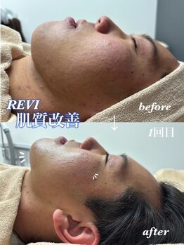 クロズキン なんば店(Kurozukin)の写真/メンズもフェイシャルケアする時代！毛穴・ニキビケア&速効性◎REVIの次世代ハーブピーリングで肌質改善★