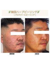 バブル(BUBRU)/グロウパールピーリング(ハーブ)