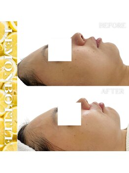 リアム(LiAm)/脂肪分解剤《レモンボトル》