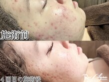 リリアック(Re:Lilyac)の雰囲気（#エステ#毛穴洗浄#脱毛#ハーブピーリング#四ツ谷三丁目#耳ツボ）