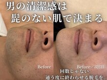 濃いヒゲ・青いヒゲも数回で変わる！メンズ脱毛VIO玉竿の照射◎