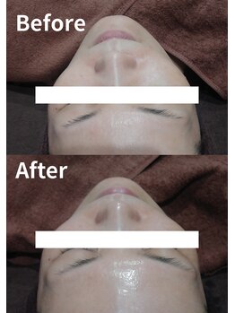 ユウユウ(YUYU)/純粋レチノールピール