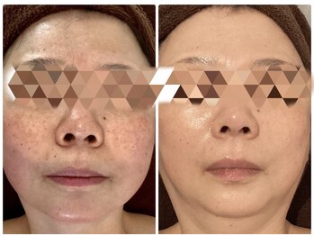 リツイート(ReTweet)/ララピール