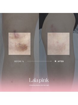 カルム(Calme)の写真/韓国発Lalapinkララピンクで叶える透明感！魅せる透明美肌へ。脱毛効果も爆上がり↑