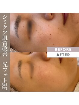 クラージュの写真/お化粧で隠せなくなったシミでお悩みの方に！1人1人に合うシミケアをご提案♪皆がやってる光フェイシャル★