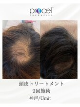 ユミト(Umit)/プロセルスカルプ