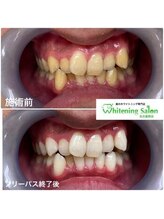 ホワイトニングサロン 名古屋駅店/【ホワイトニング施術例】