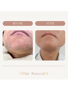 サロンエピ(Salon Epi)/全顔脱毛/メンズ脱毛/京都