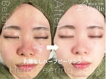 ベル 広島(Belle)/ハーブピーリング｜ニキビケア