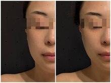 トリニティスペース(TrinitySpace)/レモンボトルビフォーアフター