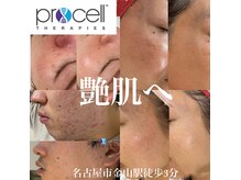 お肌のお悩み【プロセルセラピーズ】