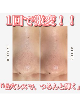 ホリシア 博多(HORISHIA)/ハーブピーリング/ニキビケア