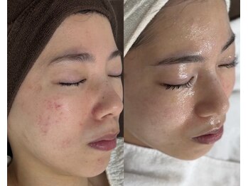 シェリー トウキョウ 西葛西店(Cherie Tokyo)/繰り返さないニキビケア◎