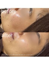 ルルラ リコ(lulula rico)/症例写真/ハーブピーリング