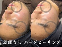 ダリア(Dahlia)/剥離なしハーブピーリング