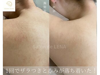 サロンドレナ 名駅店/ハーブピーリング サロンドレナ