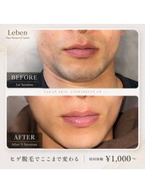レーベン 戸畑店(Leben)/ヒゲ脱毛