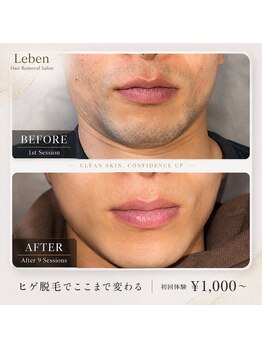 レーベン 戸畑店(Leben)/ヒゲ脱毛