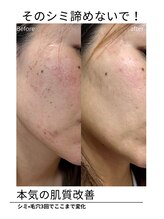 エイチケービューティーサロン(H/K beauty salon)/【シミ諦めないで】