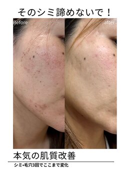 エイチケービューティーサロン(H/K beauty salon)/【シミ諦めないで】