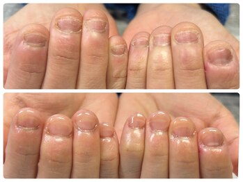 フェリス(Feliz)の写真/その爪、隠さなくても大丈夫。深爪矯正変わる第一歩。他店で断られた方も大歓迎