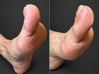 ヴィーナスオブジョー(Venus of jaw)の写真/ガサガサ・カチカチ・ひび割れかかとをケアし、しっとりなめらかな足裏を叶えます