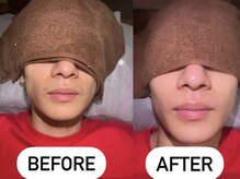 ソーレエルーナ(SOLE e LUNA)/光脱毛　メンズ　新宿