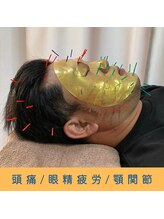 いつつのき/美容鍼