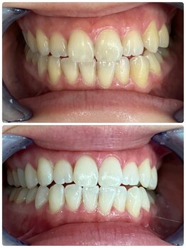 シャイニー 仙台駅東口(SHINY)/歯科提携ジェル4回目のお客様