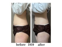 アヴァン(AVANT)/脂肪冷却1回ビフォーアフター