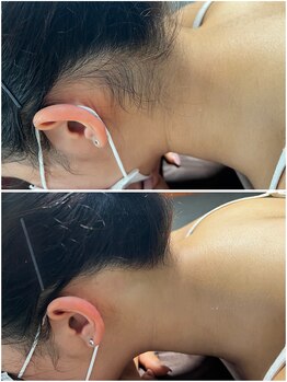 ミスターアンドミス脱毛専門店 難波店(Mr.&Ms.脱毛専門店)/えり足・うなじ脱毛