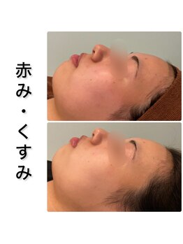 ビオプラス(BioPlus+)/川崎 /ハーブピーリング