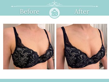 美人バスト 名古屋店/【バストアップ】症例★