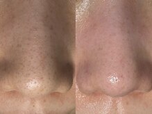 サラグランデ(Sara Grande)/毛穴エクストラクション