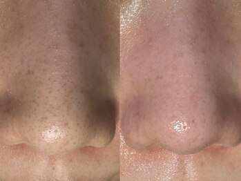 サラグランデ(Sara Grande)/毛穴エクストラクション