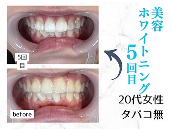 ルカノン(le canon)/近距離でも堂々と笑えます!(^^)!
