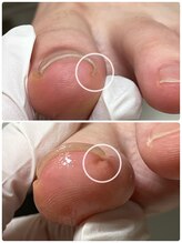 巻き爪フットケアサロン 神楽坂/アクリル巻き爪ケア片側