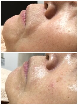 ザ フェース 東京目黒店(THE FAITH)/たるみ改善