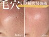 肌質改善！痛いけど効果あり！【プラズマ】