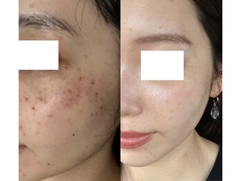 ティアラビューティ/たるみケア、毛穴の開き改善